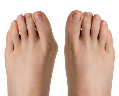 Hallux valgus before and after surgery clipart