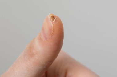 Mutfakta geçirdiği bir kazadan sonra yara izi olan kadın başparmağı beyaz arka planda izole edilmiş.