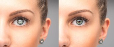 Katarakt çıkarmadan önce ve sonra kadın gözü.