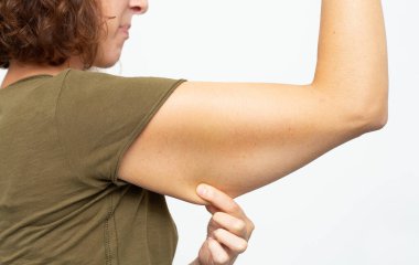 Flabby skin on arm after weight loss clipart