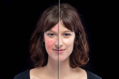 Lazer tedavisinden önce ve sonra Rosacea. Kafkasyalı genç bir kızın yüzünden başarılı bir şekilde silindi.