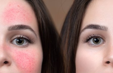 Genç beyaz bir kız, Rosacea belirtilerini ortadan kaldırmak için yoğun lazer tedavisinin sonuçlarını gösteriyor. Yanak kızarıklığında gözle görülür bir azalma