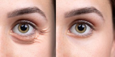 cilt yaşlanmasına karşı kozmetik etkiler: tedaviden önce ve sonra