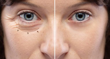 Before and after a rejuvination treatment, wrinkles and crow's feet removal Lines and arrows shows blepharoplasty zone clipart