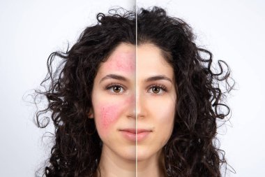 Collage comparing close up before and after successful rosacea treatment on face. Beautiful caucasian young lady portrait on white background. Medicine and healthcare concept. clipart