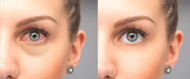 Kırmızı gözlü kadın göz damlasından önce ve sonra yıkanıyor.