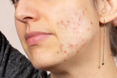 Kadın yüzünün sol tarafı sivilceli.