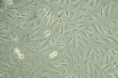 Mikroskop altında insan kanser hücreleri