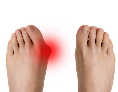 Ameliyattan önce ve sonra Hallux valgus