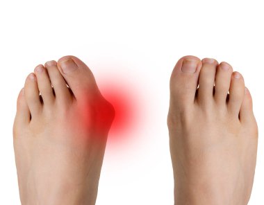 Hallux valgus before and after surgery correction clipart