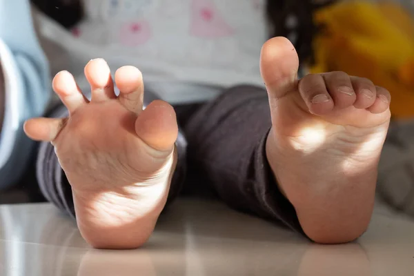 Gros Orteil Varisme Dans Les Pieds Enfant — Photo