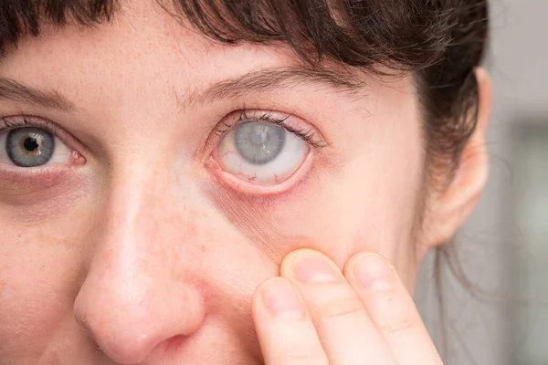 Woman with cataract on eye and corneal opacity