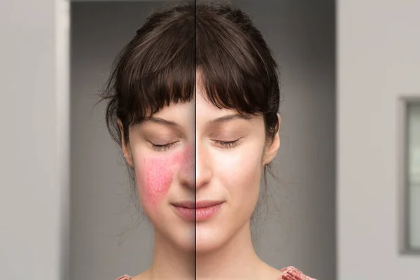 Rosácea Antes Depois Tratamento Cosmético Doenças Pele — Fotografia de Stock