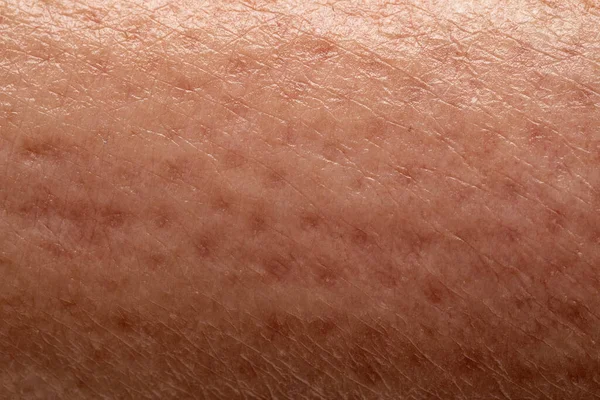 Buccia Arancia Sulla Pelle Femminile Delle Gambe Vicino Cellulite Causata — Foto Stock