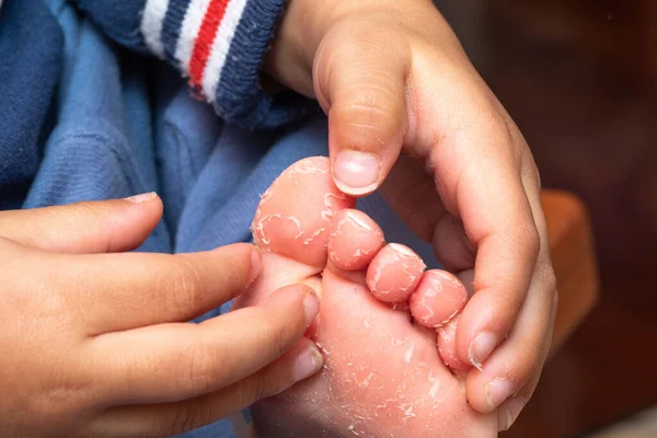 Dermatosis Plantar Juvenil Una Afección Común Crónica Piel Seca Los — Foto de Stock