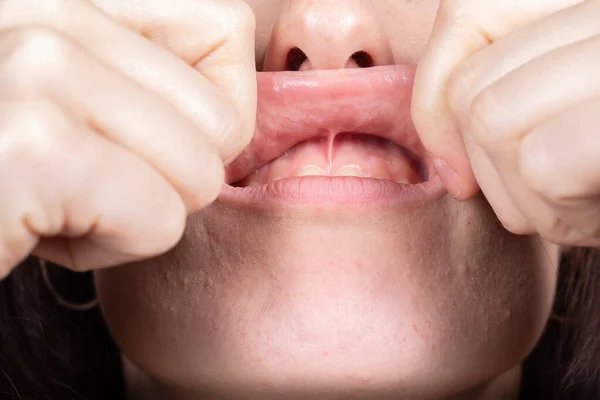 Inspeção Médica Frênulo Labial Superior Para Avaliar Necessidade Frenectomia Cirurgia — Fotografia de Stock