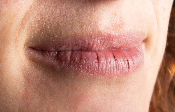 Macro Van Vrouwelijke Gebarsten Lippen — Stockfoto