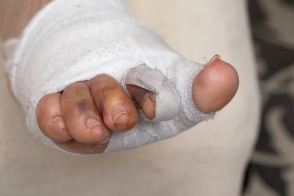 Closeup of foot bandaging post hallux valgus surgery