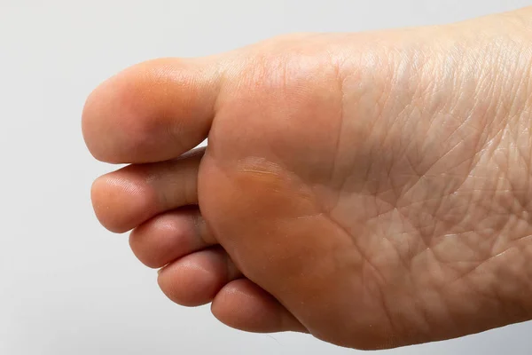 Wrinkles and calluses under the sole of a woman's foot