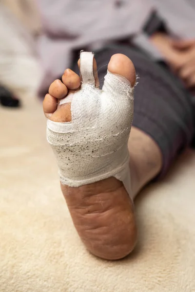 Hallux valgus operated. Banded foot sole after corrective surgery for bunion