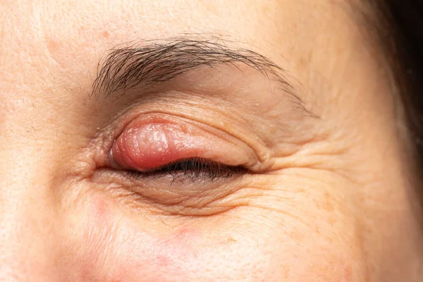 女性の目の上まぶたに腫れたシャラジオン 炎症による顕著な腫れや発赤 — ストック写真