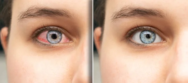 Detalhe Olho Irritado Vermelho Das Mulheres Antes Depois Tratamento Com — Fotografia de Stock