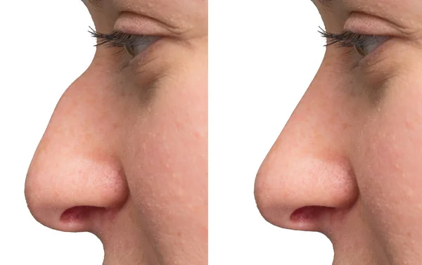 Tutup Hidung Sebelum Dan Setelah Operasi — Stok Foto