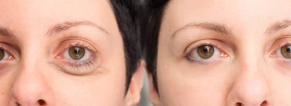 Eye of woman before and after cosmetic treatment for wrinkles re