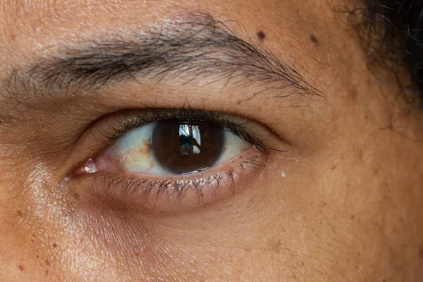 Manchas Pigmentadas Escuras Esclera Olho Masculino Humano São Geralmente Inofensivas — Fotografia de Stock