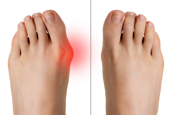 Comparison Bunion Correction Surgery — Stock Photo, Image