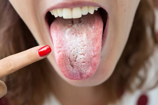 Woman with halitosis for candida albicans pointing her tongue wi