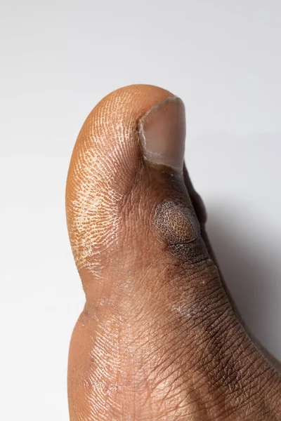 Trockene Haut Den Fingern Wie Man Trockener Haut Entgegenwirkt — Stockfoto