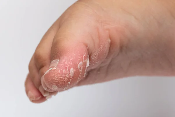 Blasen Und Peeling Der Haut Konzept Der Fußgesundheit — Stockfoto
