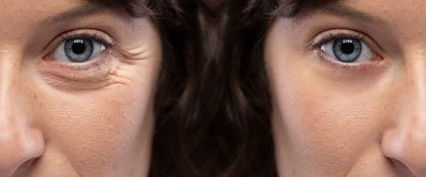 Half Face Girl Rejuvination Treatment Eye Wrinkles Crow Feet — Stock Photo, Image