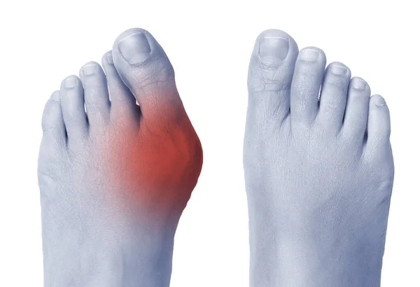 Female Foot Bunion Big Toe — Stock Photo, Image