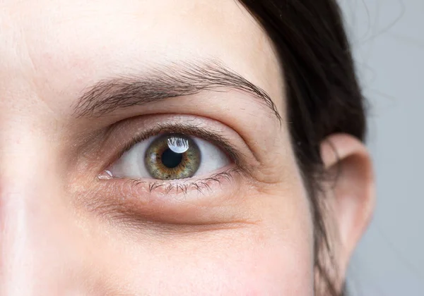 Macro Imagen Mujer Ojo Hinchado Mujer Con Bolsas Para Los — Foto de Stock