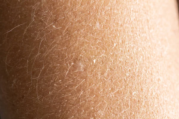 Closeup Shot Skin Blemishes — Stock Photo, Image