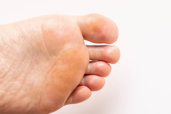 Callous Skin Tissue Human Foot Sole Isolated White Copy Space — Stock Photo, Image