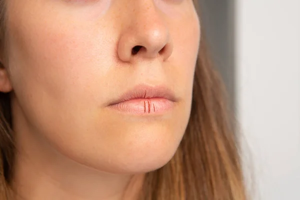 Vrouw Met Droge Lippen — Stockfoto