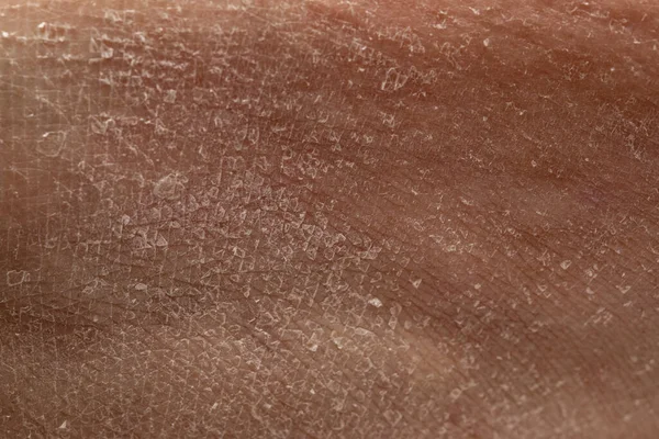 Pathological peeling of the skin due to keratosis. Details of the flaking human skin scales