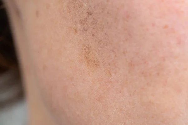 Closeup Shot Skin Blemishes — Stock Photo, Image