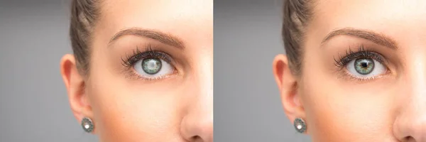 Katarakt Çıkarmadan Önce Sonra Kadın Gözü — Stok fotoğraf