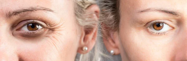 Kadından önce ve sonra karşılaştırıldığında göz çıkarmanın altındaki siyah halkalar.