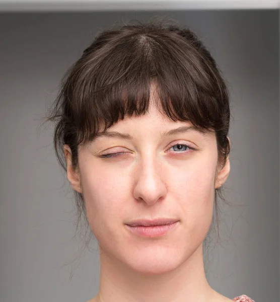 Mujer Con Hemiparesia Facial — Foto de Stock