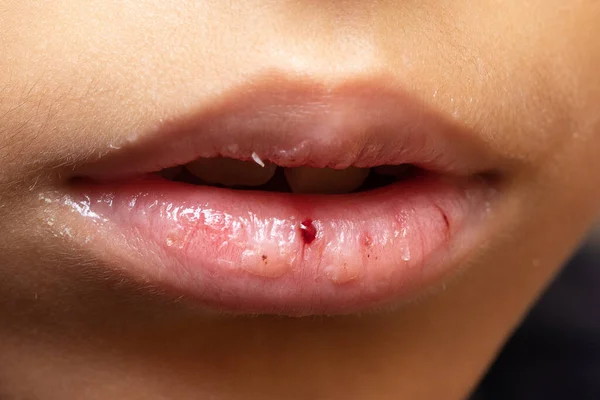 Rissige Lippen Eines Kindes Mit Offensichtlichen Anzeichen Von Dehydrierung — Stockfoto