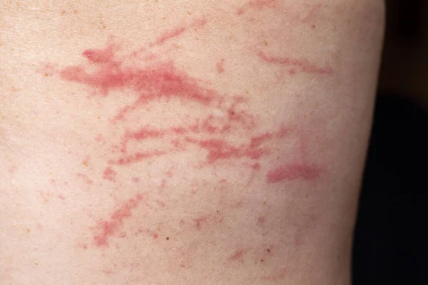 Excoriations Skin Due Scratches Due Severe Itching — Stock Photo, Image