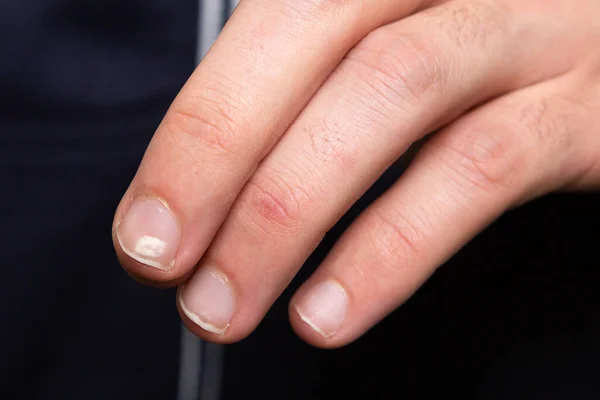 Fingernaglar Visar Tecken Kalciumbrist Makro Pojkes Hand — Stockfoto