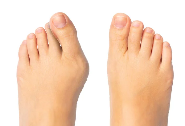 Hallux valgus ameliyatı için ameliyattan önce ve sonra kadın ayakları.