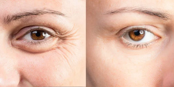 Olho Enrugado Bela Senhora Antes Depois Tratamento Cosmético — Fotografia de Stock