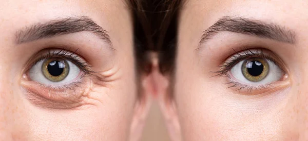 Before and after eye bags and wrinkles removing comparison. Closeup view of aged caucasian women eyes.